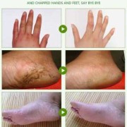 我的脚后跟裂开了，有裂口疼怎么办呢,孕期后脚跟裂了可以擦什么乳效果好