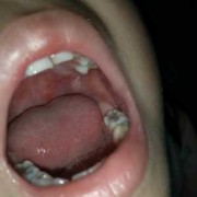 胎儿嘴唇裂（婴儿嘴巴热怎么办呢？是发烧的症状吗）