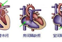 胎儿室间隔缺损会变大吗,胎儿室间隔肌部缺损2mm严重吗