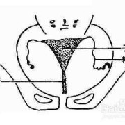 怀孕了右侧附件区囊肿怎么办,孕期脓肿护理问题及措施图片