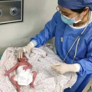 七个月早产儿2斤以后长大会不会有后遗症？早产儿饮食该注意,七个月胎儿体重多少是正常的
