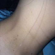 孕期乳晕上长了小肉粒