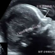 12周胎儿视频（12周胎儿鼻骨缺失是畸形吗）