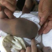 宝宝手背脚背上有胎青,胎儿的胎记是怎么造成的