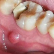孕期根尖炎（孕期根尖炎疼怎么缓解）