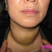 孕期甲亢症状（孕期甲亢症状表现）