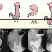 胎儿胃偏小（胎儿胃偏小怎么回事）