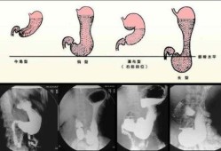 胎儿胃偏小（胎儿胃偏小怎么回事）
