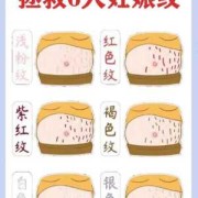 孕期妊娠纹怎么消除（妊娠纹怎么样能淡化）