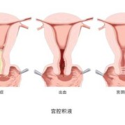 积液对胎儿有影响吗（怀孕宫颈积液对胎儿有影响吗）
