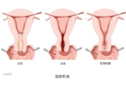 积液对胎儿有影响吗（怀孕宫颈积液对胎儿有影响吗）