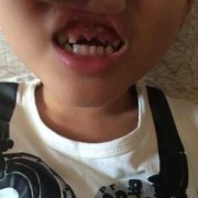 胎儿上牙槽骨（儿童牙齿长在牙龈上）