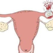 孕期出血腹痛（怀孕肚子疼流血是怎么回事）