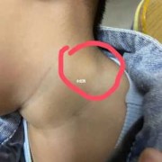 胎儿后颈部（宝宝切除扁桃体后耳朵下淋巴结肿大）