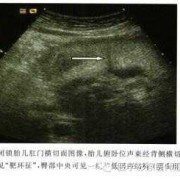 胎儿肛门闭锁超声图像（胎儿肛门闭锁超声图像）