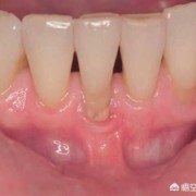孕期牙龈萎缩（牙龈萎缩了还可以恢復吗）