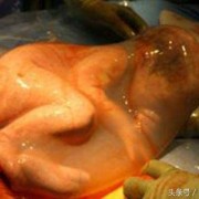 孕妇羊水脏影响胎儿是什么,羊水没了胎儿会怎么样呢