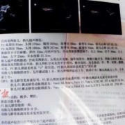 胎儿b超报告（胎儿b超报告单怎么看）