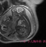 胎儿心脏积液对胎儿有影响吗,孕妇积水对胎儿的影响有哪些