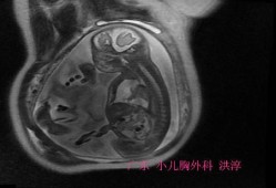 胎儿心脏积液对胎儿有影响吗,孕妇积水对胎儿的影响有哪些