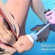 胎儿吸引器（胎儿吸引器助产录像0101）