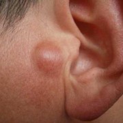胎儿丘脑后上方囊肿（胎儿丘脑后上方囊肿）
