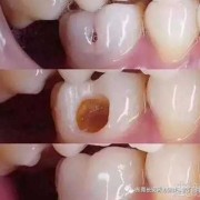 孕期能补牙吗,孕期补牙齿可以吗