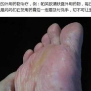 孕妇得脚气怎么办,孕期脚气怎么办?