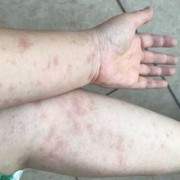 备孕期间吃了过敏药，对怀孕有影响吗,备孕期间过敏了怎么办呢