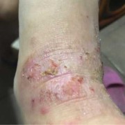 孕期湿疹什么样（请问大家孕妇湿疹怎么止痒啊）