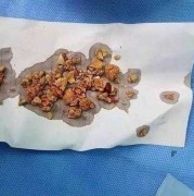 孕期有结石（孕妇有肾结石的问题，不是很严重，怀孕期间能够喝牛奶吗）