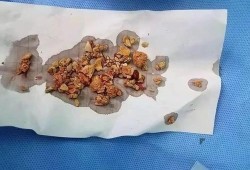 孕期有结石（孕妇有肾结石的问题，不是很严重，怀孕期间能够喝牛奶吗）