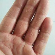 孕期手指脱皮（谁知道孕妇的腿上脱皮比较严重，应该怎么办）