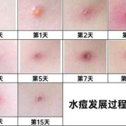 孕妇水痘对胎儿的影响（出水痘的危害有哪些）
