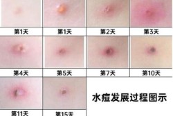 孕妇水痘对胎儿的影响（出水痘的危害有哪些）