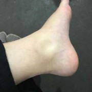 浮肿孕期（怀孕为什么脚会肿，怀孕脚肿怎么办）