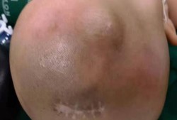 婴儿脑积水有什么症状,胎儿脑积水症状有哪些