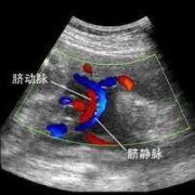 孕5个月单脐动脉胎儿其他都正常,单胎图片 b超