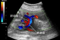 孕5个月单脐动脉胎儿其他都正常,单胎图片 b超
