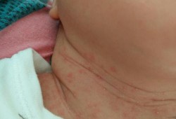 孕妇怎么预防胎儿湿疹（怀孕了长湿疹怎么办）