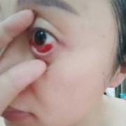 孕期眼底充血（孕期眼底充血后期会恢复吗）