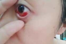 孕期眼底充血（孕期眼底充血后期会恢复吗）