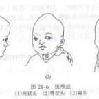 胎儿小头畸形的诊断标准是怎样的？怀孕8个月多，要注意什么呢,怎么确认胎儿小头畸形图片