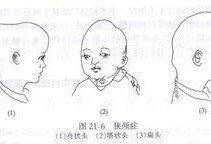胎儿小头畸形的诊断标准是怎样的？怀孕8个月多，要注意什么呢,怎么确认胎儿小头畸形图片