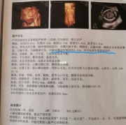 孕23周胎儿小脑横径宽该怎办啊呢？一般出生之后会不会有什么,胎儿小脑宽是怎么回事