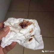 孕期分泌物发黄（怀孕期间白带发黄怎么回事）