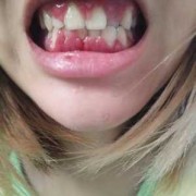 孕期牙龈肿出血怎么办,孕期牙龈肿大,牙肉突出怎么办