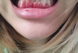 孕期牙龈肿出血怎么办,孕期牙龈肿大,牙肉突出怎么办