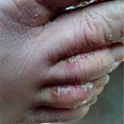 孕期得了脚气（孕期得了脚气怎么办）