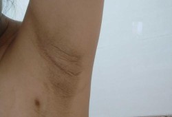 怀孕腋下变黑怎么办,孕期腋下变黑怎么恢复正常